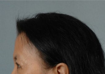 45-54 year old woman treated with Asian Eyelid Surgery after 3615939