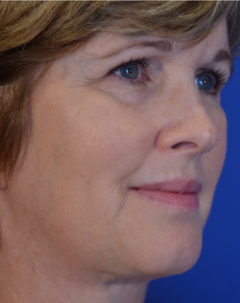 58 year old woman post Facelift, Upper Eye Lid Blepharoplasty and Fat Transfer to the cheeks after 3743029
