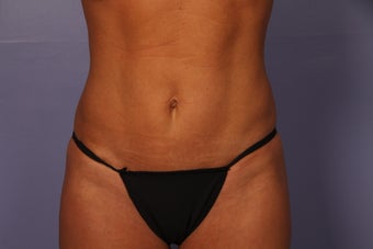 42 yr old wanting a mommy makeover after 1072951