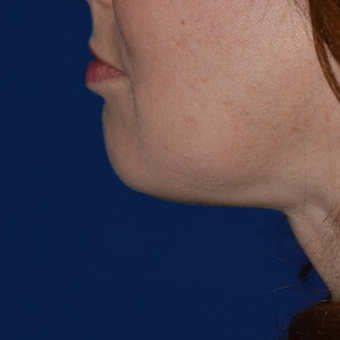 35-44 year old woman treated with Lipodissolve after 3755305