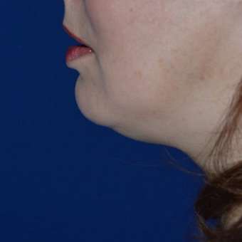 35-44 year old woman treated with Lipodissolve before 3755305
