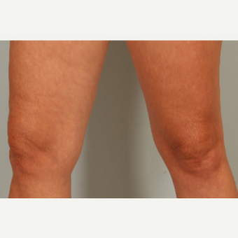 46 year old with aging knees treated with microneedling and hyaluronic acid single treatment after 3452994