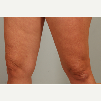 46 year old with aging knees treated with microneedling and hyaluronic acid single treatment before 3452994