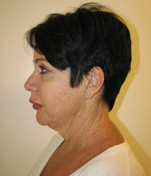 Neck Lift Before and After before 718882