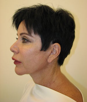 Neck Lift Before and After after 718882