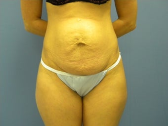 36 year old woman unhappy with the appearance of her abdomen after having 4 children before 1253753