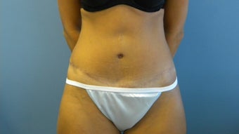 36 year old woman unhappy with the appearance of her abdomen after having 4 children after 1253753