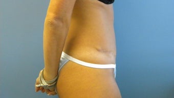 36 year old woman unhappy with the appearance of her abdomen after having 4 children 1253753
