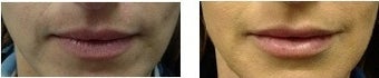Filler for Fuller Lips before 770814