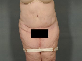 Age: 52, Height: 5"10", Weight: 236lbs. after 1306678
