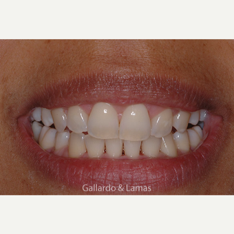 35-44 year old woman treated with Gum Lift after 3127719