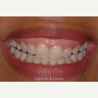 35-44 year old woman treated with Gum Lift before 3127719