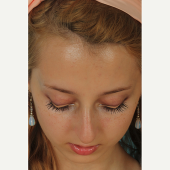 25-34 year old woman treated with Rhinoplasty before 3628976