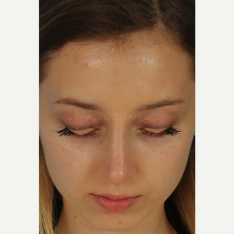 25-34 year old woman treated with Rhinoplasty after 3628976