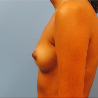 20 year old woman treated with saline Breast Implants. 290 cc high profile filled to 300 cc. A to before 3304523