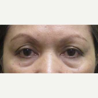 55-64 year old woman treated with upper and lower eyelid Surgery before 3220043