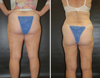 Thigh Lift before 1149471