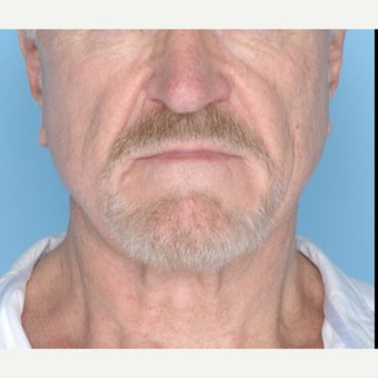 65-74 year old man treated with Ultherapy after 1794399