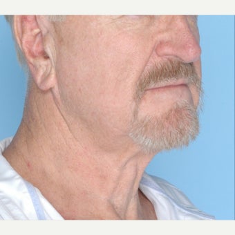 65-74 year old man treated with Ultherapy 1794399