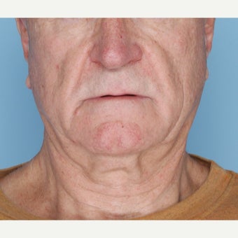 65-74 year old man treated with Ultherapy before 1794399