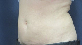 SculpSure Lower Abdomen 1 Treatment after 7 wks after 3266298