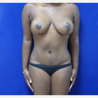 32 y.o. – female – Wise pattern mastopexy with abdominoplasty (mommy makeover) after 3401329