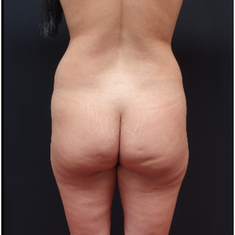 25-34 year old woman treated with Liposuction before 3267112