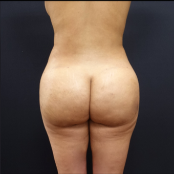 25-34 year old woman treated with Liposuction after 3267112