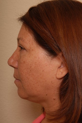 Liposuction of the Neck before 252805