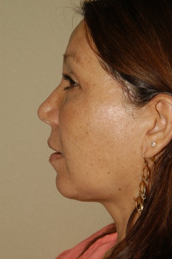 Liposuction of the Neck after 252805