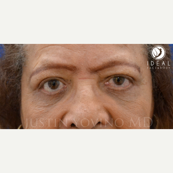 65-74 year old woman treated with Eye Bags Treatment, lower and upper Eyelid Lift after 1648383