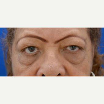 65-74 year old woman treated with Eye Bags Treatment, lower and upper Eyelid Lift before 1648383