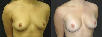 27 year old woman treated with Breast Augmentation before 2990465