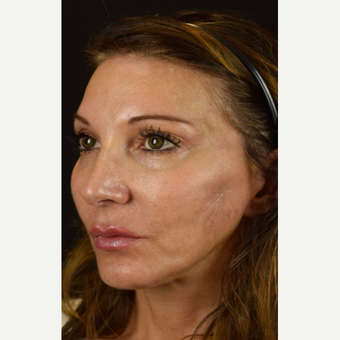 Facial Scars Treated with Microneedling after 3005349
