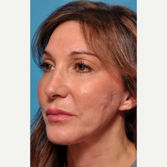 Facial Scars Treated with Microneedling before 3005349