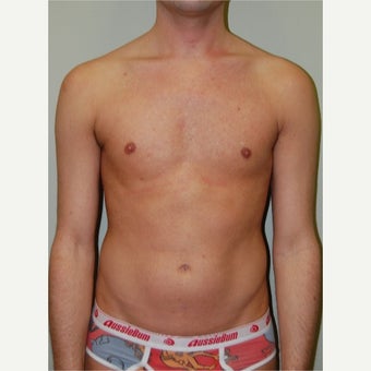 25-34 year old man treated with Pec Implants before 2533347