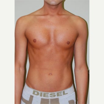 25-34 year old man treated with Pec Implants after 2533347