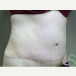 44 year old woman treated with Tummy Tuck after 3484890