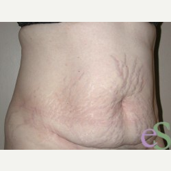 44 year old woman treated with Tummy Tuck before 3484890