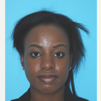 25-34 year old woman treated with open Rhinoplasty including alar base reduction after 2680398