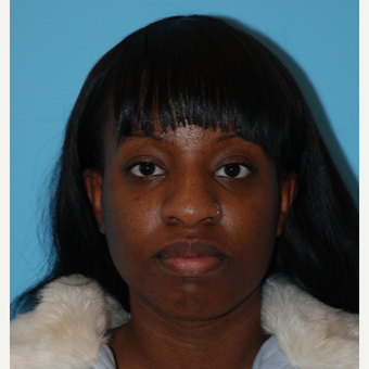 25-34 year old woman treated with open Rhinoplasty including alar base reduction before 2680398