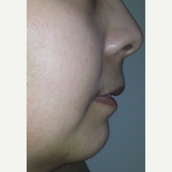 18-24 year old woman treated with Chin Implant after 3554854