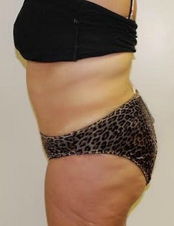 45-54 year old woman treated with a Tummy Tuck. 1866778