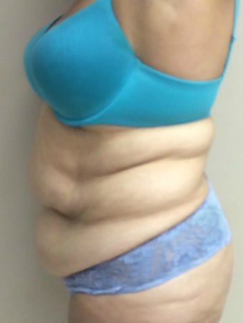 45-54 year old woman treated with a Tummy Tuck. 1866778
