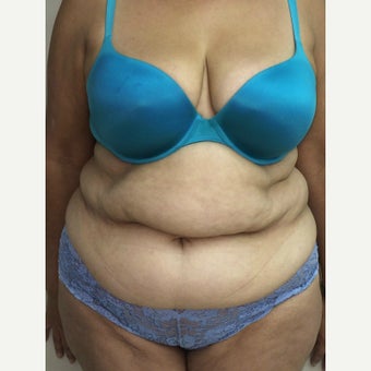 45-54 year old woman treated with a Tummy Tuck. before 1866778