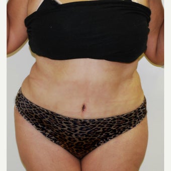 45-54 year old woman treated with a Tummy Tuck. after 1866778