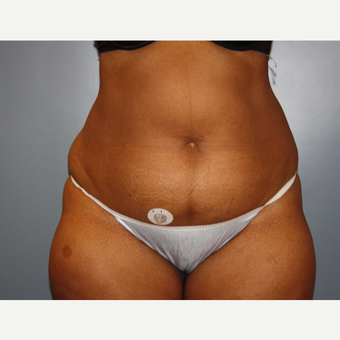 45-54 year old woman treated with Liposuction before 3683145