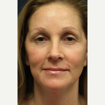 44 year old woman treated with Laser Resurfacing after 1555553