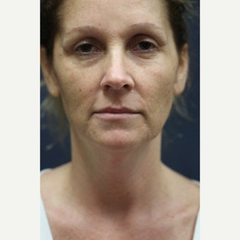 44 year old woman treated with Laser Resurfacing before 1555553