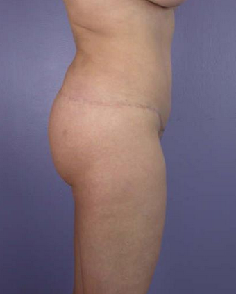 45-54 year old woman treated with Butt Lift after 1677511